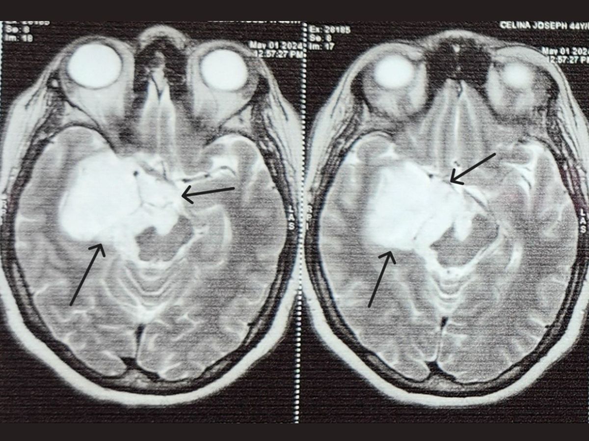 DR. L H HIRANANDANI HOSPITAL SUCCESSFULLY TREATED RARE EPILEPSY CASE THROUGH NEUROSURGERY